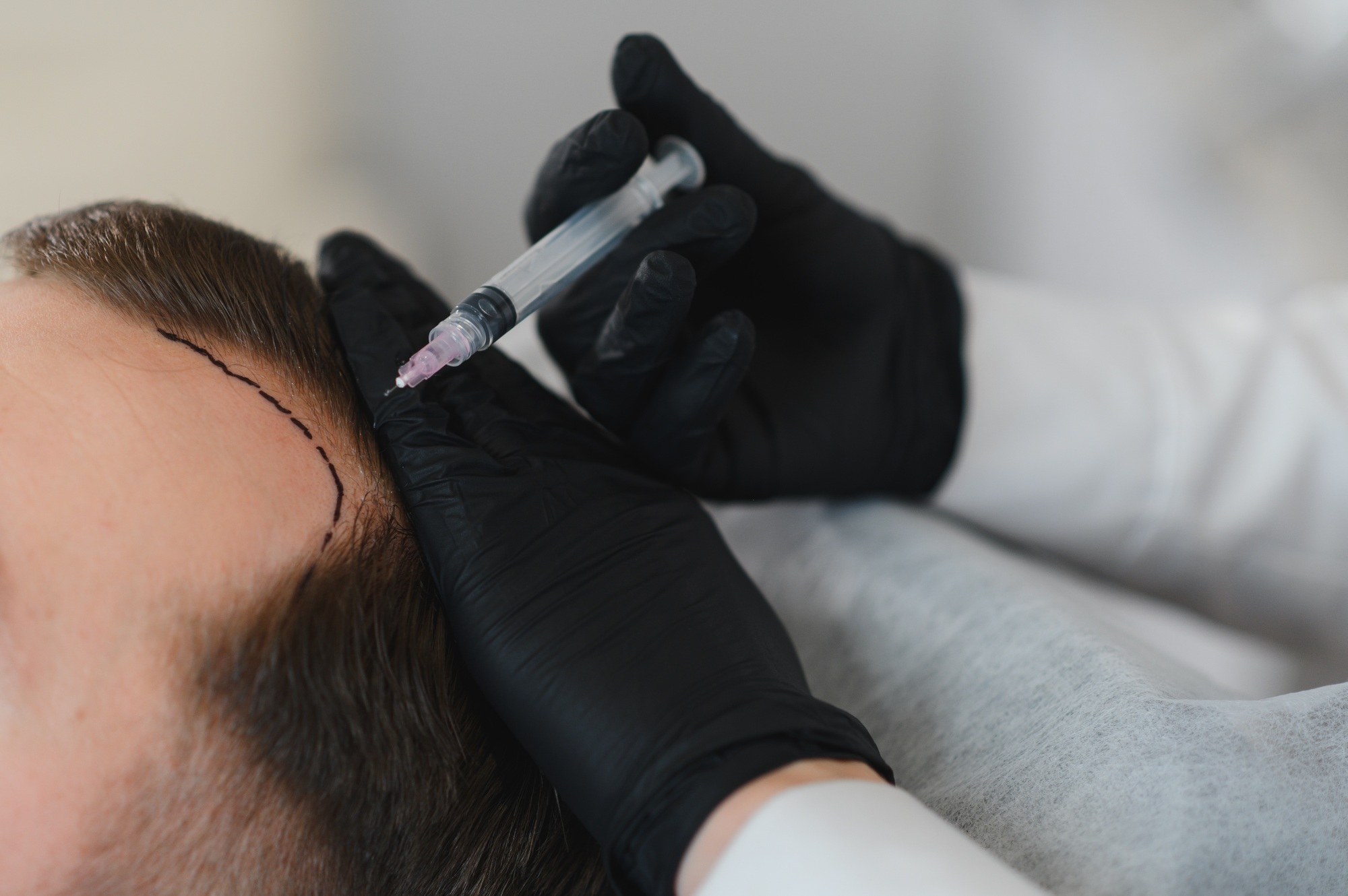 Mesotherapy for hair. Attractive man receiving injections in his head